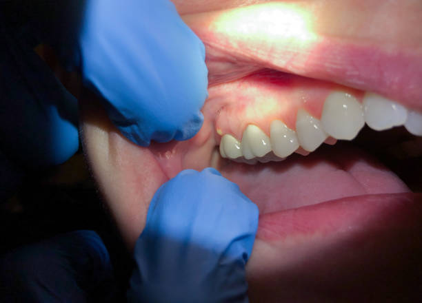 Best Emergency Care for Gum Disease in Wiggins, MS